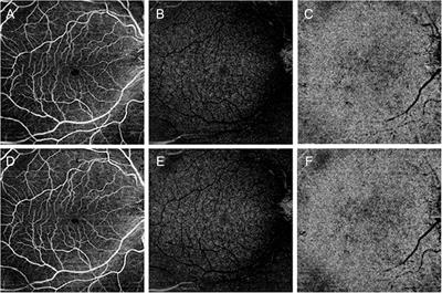 Quantitative Optical Coherence Tomography Angiography Detects Retinal Perfusion Changes in Carotid Artery Stenosis